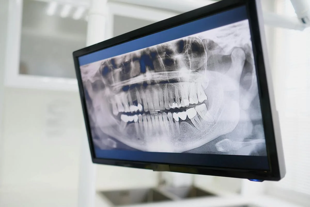 Anwendung des Direktkonversions-Röntgensensors – dentale intraorale und Panoramabildgebung