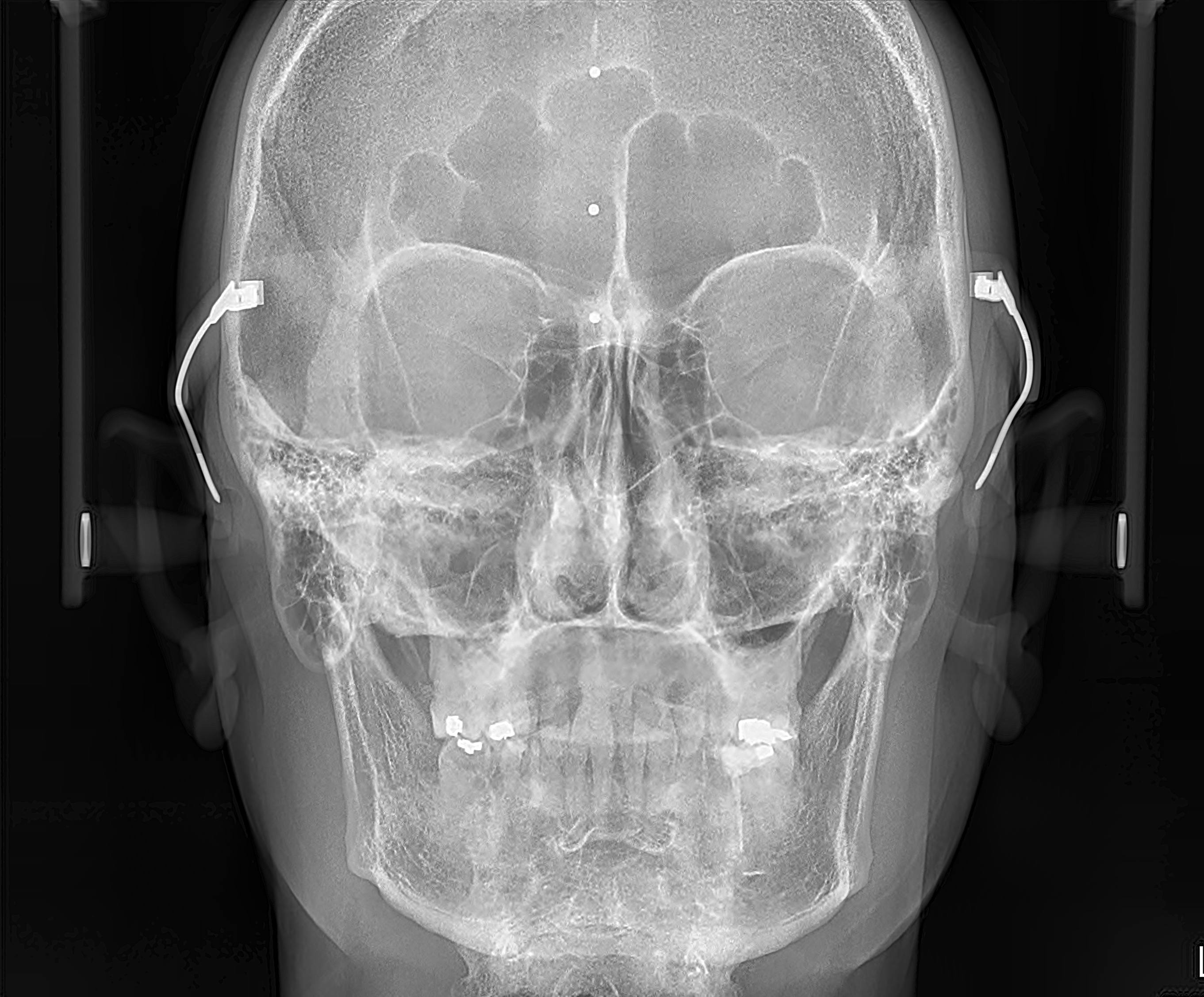 Ultra-Fast Scanning Sensor cephalo X-ray 2