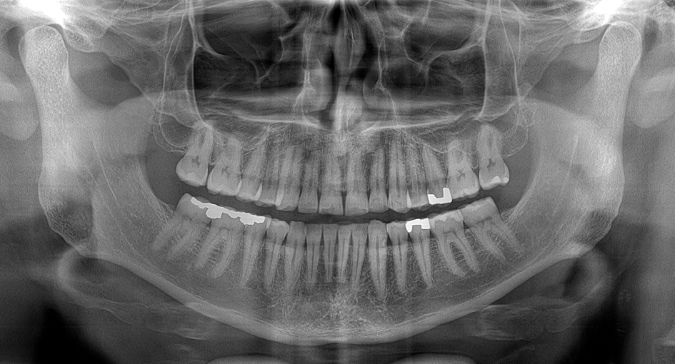 Ultra-Fast Scanning Sensor panoramic X-ray 1