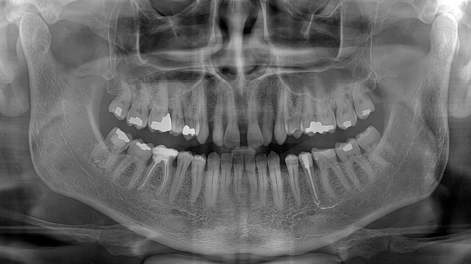 Ultra-Fast Scanning Sensor panoramic X-ray 2