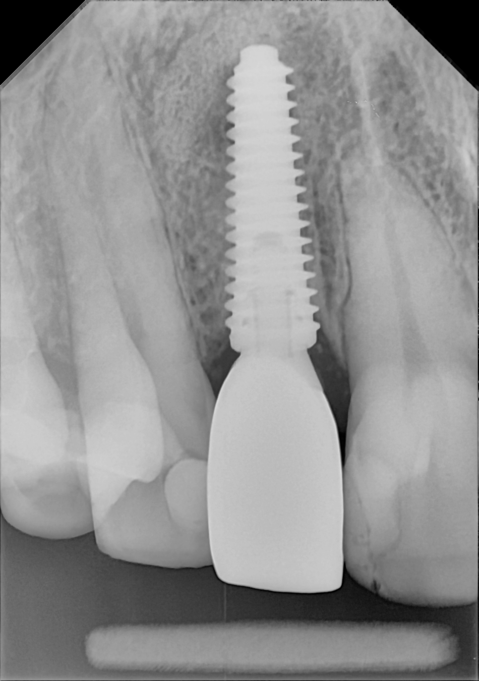 DC-Air anterior X-ray 2