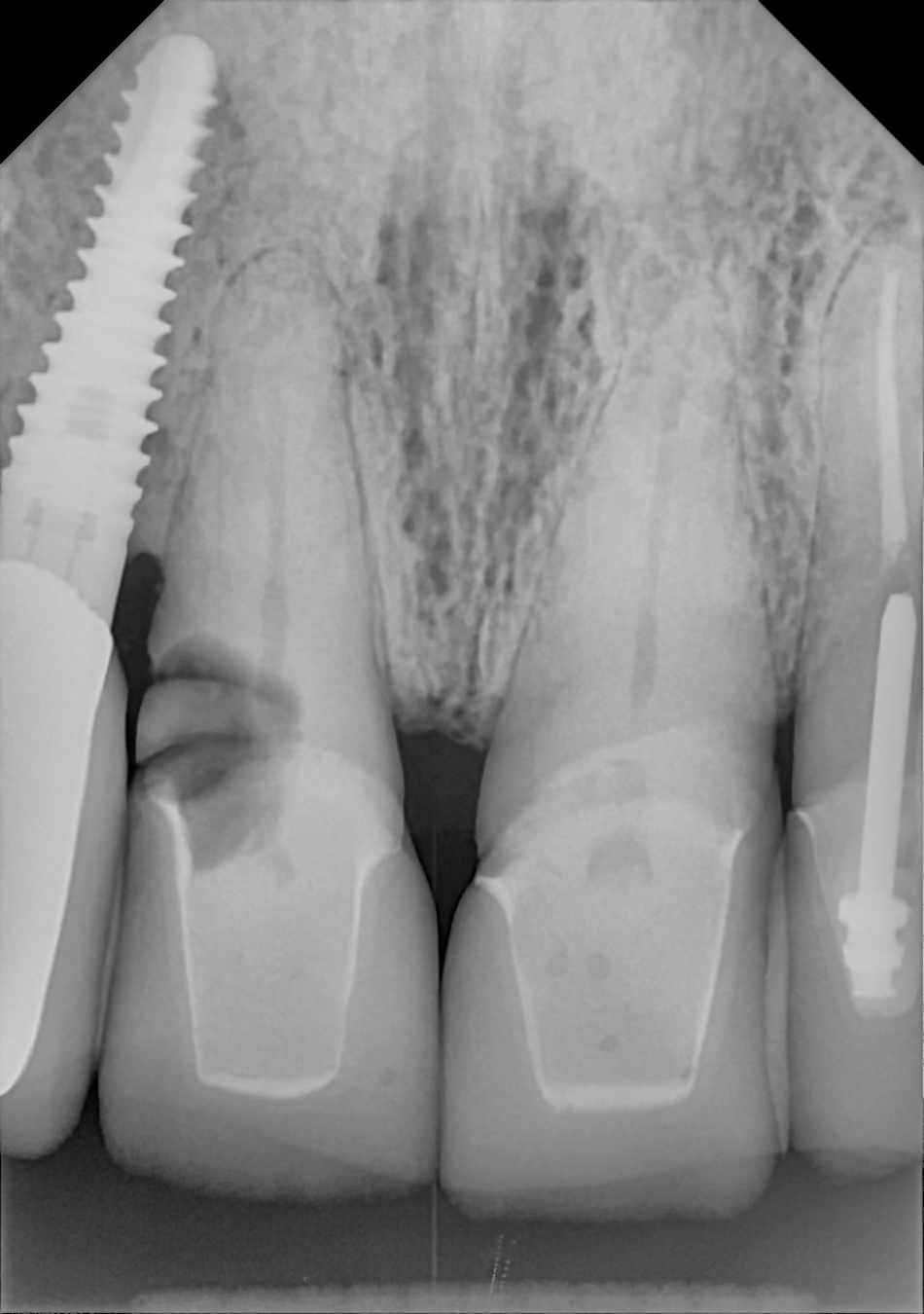 DC-Air anterior X-ray 4