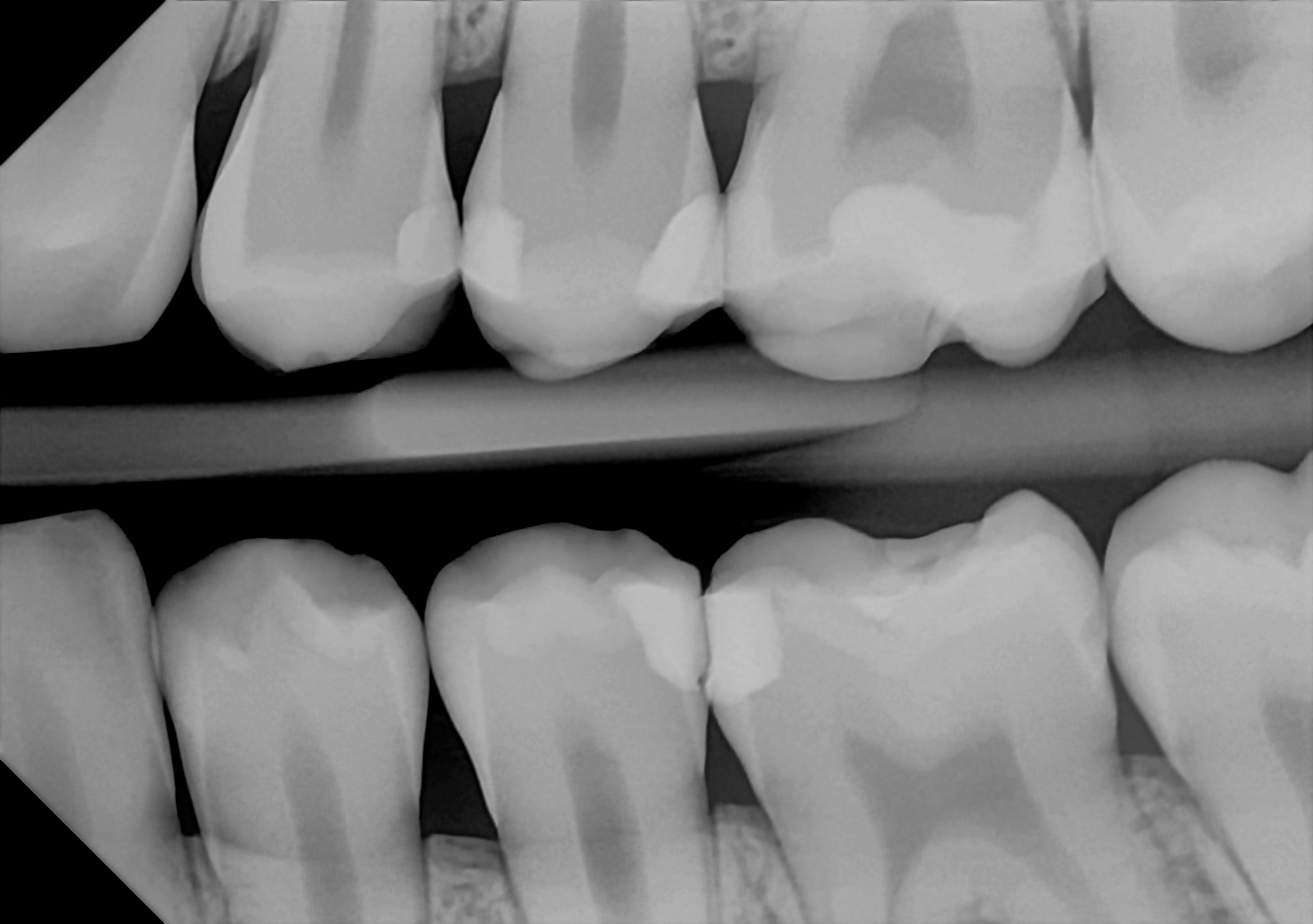 DC-Air bitewing X-ray 2