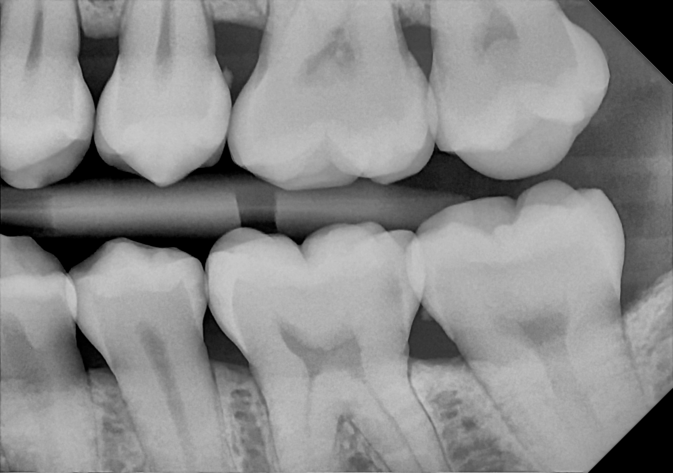 DC-Air bitewing X-ray 5