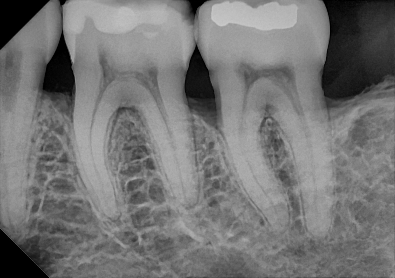 DC-Air posterior X-ray 1