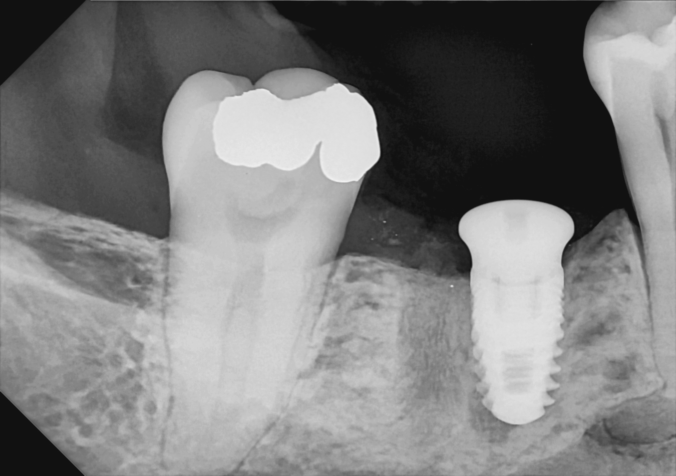 DC-Air posterior X-ray 2
