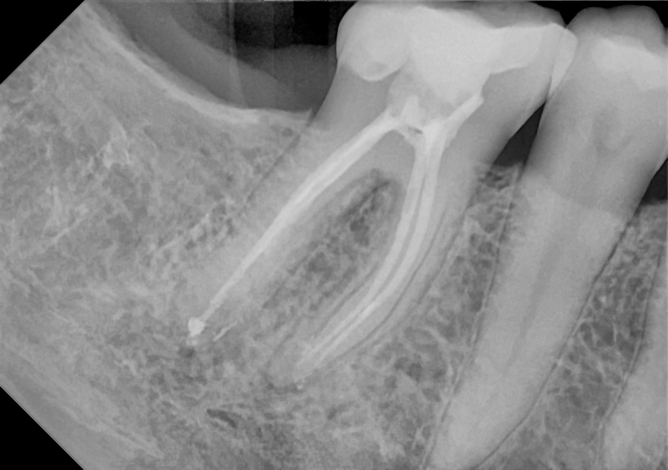 DC-Air posterior X-ray 3