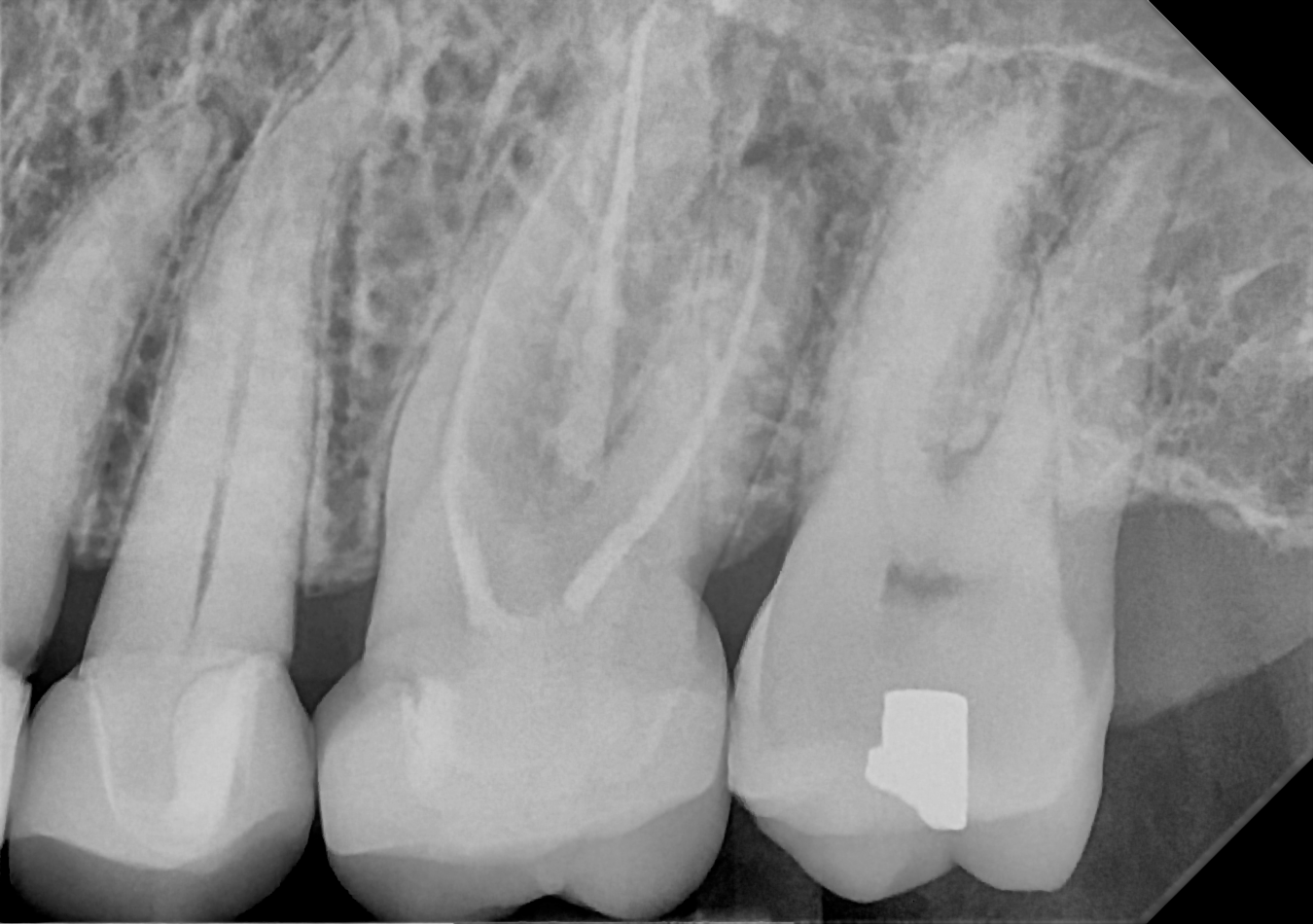 DC-Air posterior X-ray 4